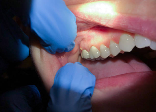 Best Emergency Root Canal Treatment in Hammond, LA